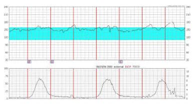 fetal monitoring strips practice|NEW and Refreshed Tracing Collections .